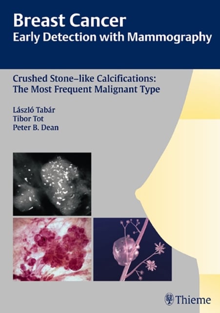 Book cover of Breast Cancer: Early Detection with Mammography